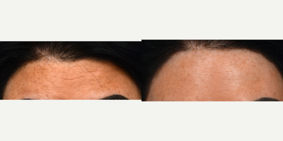 Case 4514 - 35-44 year old woman treated with Botox