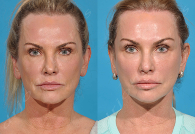 Case 4516 - 55-64 year old woman treated with Botox