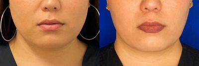 Case 4519 - Woman treated with Botox