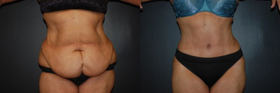 Case 452 - Woman treated with Tummy Tuck