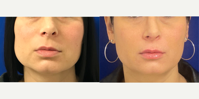 Case 4520 - 35-44 year old woman treated with Botox