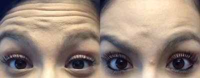 Case 4521 - 25-34 year old woman treated with Botox