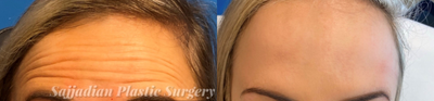 Case 4522 - 25-34 year old woman treated with Botox