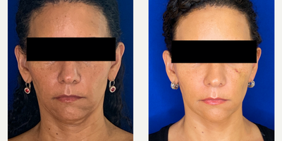 Case 4523 - 45-54 year old woman treated with Botox