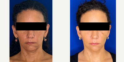 Case 4524 - 46 year old woman treated with Botox