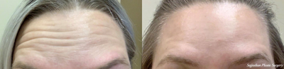 Case 4525 - 25-34 year old woman treated with Botox