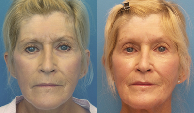 Case 4526 - 65-74 year old woman treated with Botox