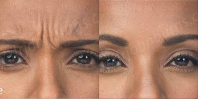 Case 4527 - Woman treated with Botox