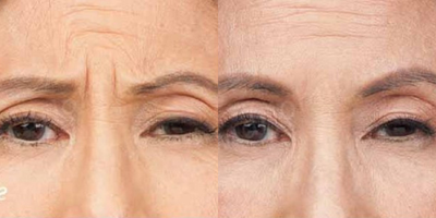 Case 4528 - Woman treated with Botox