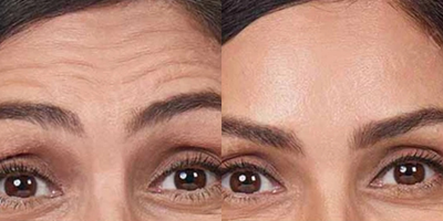 Case 4530 - Woman treated with Botox