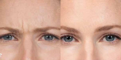 Case 4531 - Woman treated with Botox