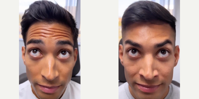 Case 4533 - Man treated with Botox