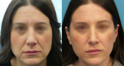 Case 4534 - 35-44 year old woman treated with Botox