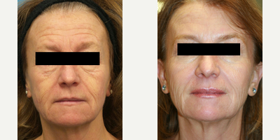 Case 4535 - 55-64 year old woman treated with Botox