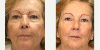 Case 4538 - 55-64 year old woman treated with Botox
