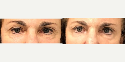 Case 4539 - 65-74 year old woman treated with Botox