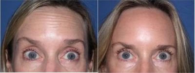 Case 4540 - Woman treated with Botox