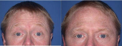 Case 4541 - 25-34 year old man treated with Botox