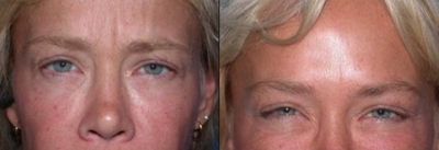 Case 4542 - Woman treated with Botox