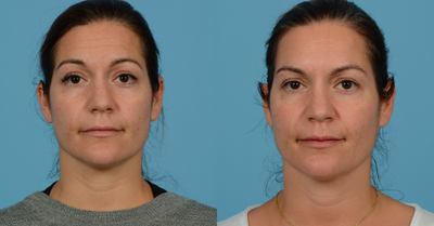 Case 4543 - 35-44 year old woman treated with Botox
