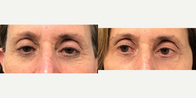 Case 4544 - 65-74 year old woman treated with Botox