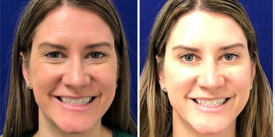 Case 4545 - 25-34 year old woman treated with Botox