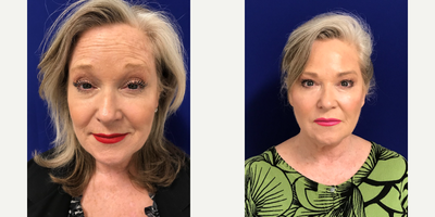 Case 4546 - 55-64 year old woman treated with Botox