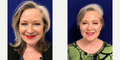 Case 4547 - 55-64 year old woman treated with Botox