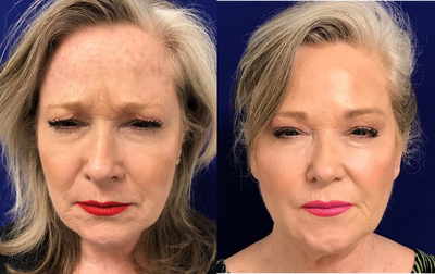 Case 4548 - 55-64 year old woman treated with Botox