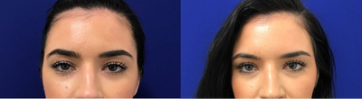 Case 4549 - 18-24 year old woman treated with Botox