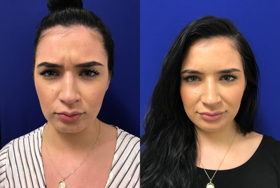 Case 4551 - 18-24 year old woman treated with Botox