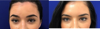 Case 4552 - 18-24 year old woman treated with Botox