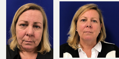 Case 4553 - 55-64 year old woman treated with Botox