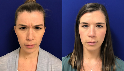 Case 4554 - 25-34 year old woman treated with Botox