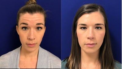 Case 4555 - 25-34 year old woman treated with Botox