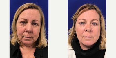 Case 4556 - 55-64 year old woman treated with Botox