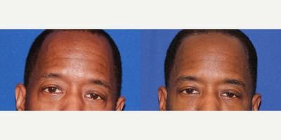 Case 4557 - 45-54 year old man treated with Botox