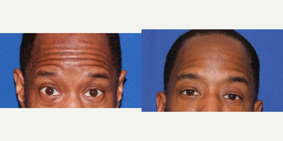 Case 4558 - 45-54 year old man treated with Botox