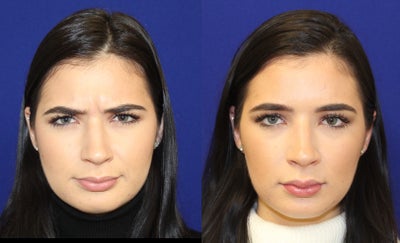 Case 4559 - 18-24 year old woman treated with Botox