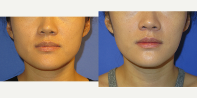 Case 4560 - 31 year old woman treated with Botox to the Masseters