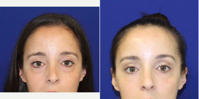 Case 4561 - 35-44 year old woman treated with Botox