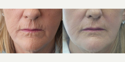 Case 4562 - 56 year old woman treated with Botox