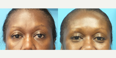 Case 4563 - 52 year old woman treated with Botox