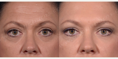 Case 4564 - 35-44 year old woman treated with Botox