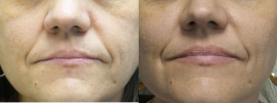 Case 4566 - 47 year old woman treated with Botox and Radiesse