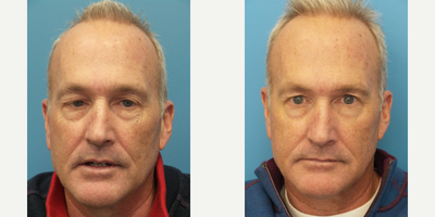 Case 4567 - 55 year old man treated with Botox