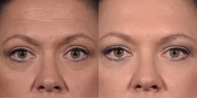 Case 4568 - 45-54 year old woman treated with Botox