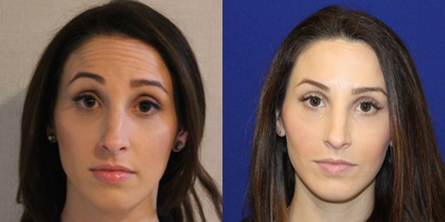 Case 4569 - 29 year old woman treated with Botox