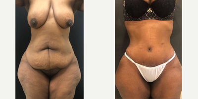 Case 457 - 35-44 year old woman treated with Tummy Tuck
