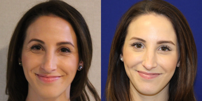 Case 4570 - 29 year old woman treated with Botox